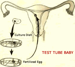 In Vitro Fertilization and Embryo Transfer (IVF-ET)