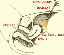 Laparoscopic (Key Hole) Surgery