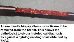 A core needle biopsy allows more tissue to be removed from the breast. This allows the pathologist to give a histological diagnosis as against a cytological diagnosis obtained by FNAC