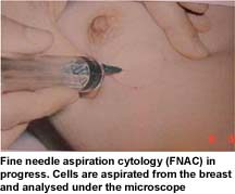 Fine needle aspiration cytology (FNAC) in progress. Cells are aspirated from the breast and analysed under the microscope