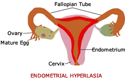 Endomerial Hyperlasia (Adenomyosis)