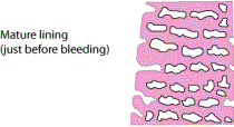 Mature Lining (just before bleeding)