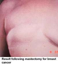 Result following mastectomy for breast cancer