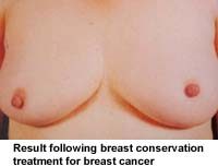 Result following breast conservation treatment for breast cancer